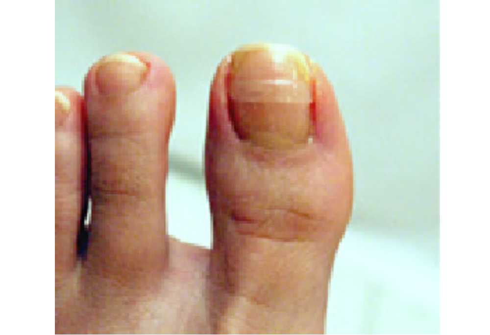 巻き爪治療の料金について ドクタリストは10万人の巻き爪治療実績の痛まない巻き爪専門治療院